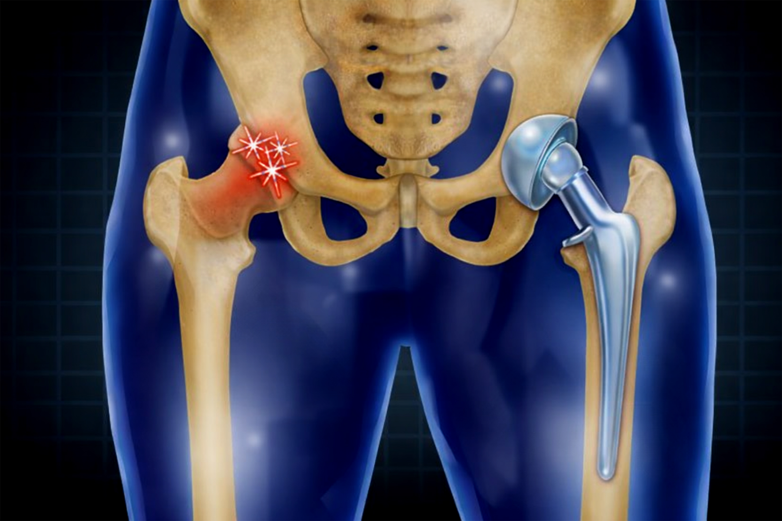 Total Hip Replacement